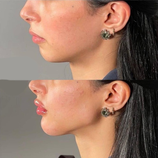 تحديد فك + شفايف