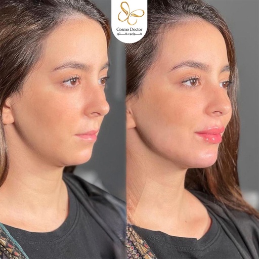 فل فيس (فك-ذقن-شفايف-خدود-تحت العين)