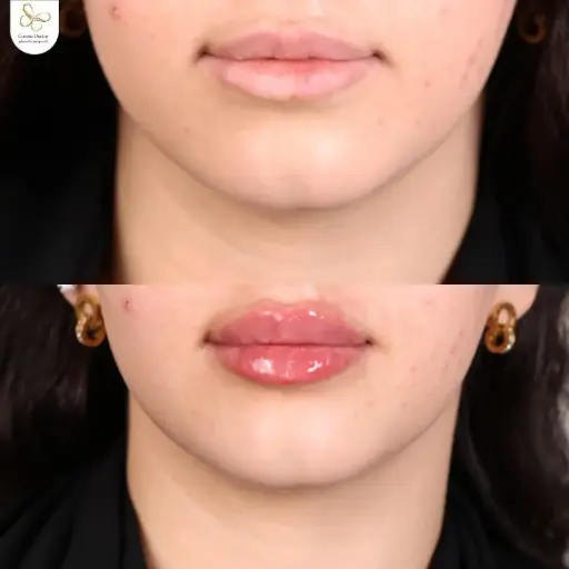 اجراء فيلر