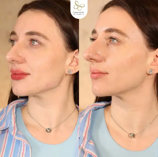 تحديد فك + شفايف