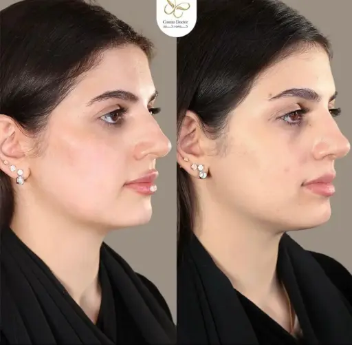 فل فيس (فك-ذقن-شفايف-خدود-تحت العين)